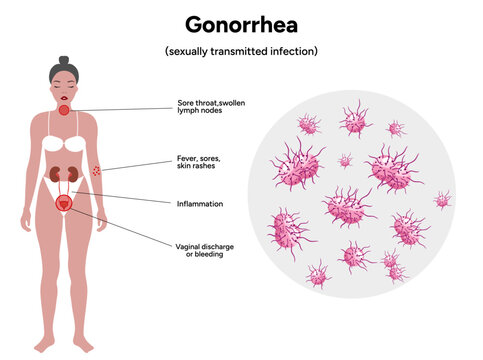 Gonorrhea. Human reproductive system transmitted infection virus bacterial. Medical diagram symptoms 