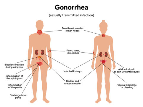 Gonorrhea. Human reproductive system transmitted infection virus bacterial. Medical diagram symptoms 