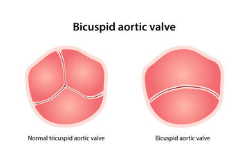Bicuspid aortic valve, congenital heart defect. Medical illustration of healthy and defective valve. Vector illustration in flat style
