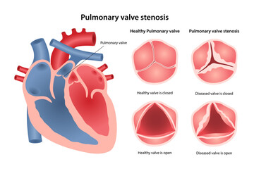 Pulmonary valve stenosis. Medical vector illustration of heart disease with image of heart showing location of pulmonary valve, healthy and diseased valve in open and closed state. Flat style