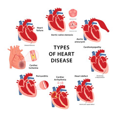 Heart disease types. Medical vector illustration of aortic valve stenosis, aortic aneurysm, cardiomyopathy, thickening of myocardium, heart defect, arrhythmia and ischemia, pericarditis, heart failure