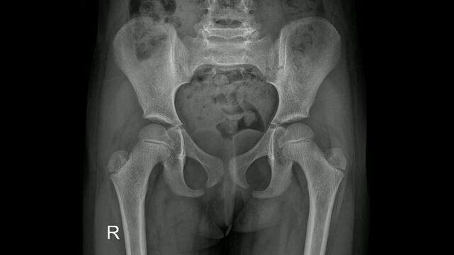 Child Pelvis AP X-Ray Showing Hip and Sacral Anatomy