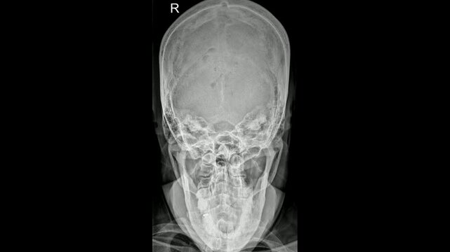 Reverse Towne's View (RTV) of Mandible X-Ray Showing Jawbone Structure