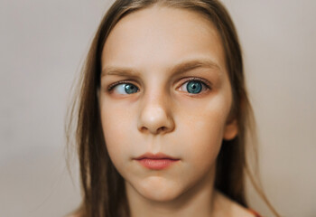 Fototapeta premium Photograph, portrait of a cross-eyed girl, a sick child with an eye disease. The concept of illness in childhood.