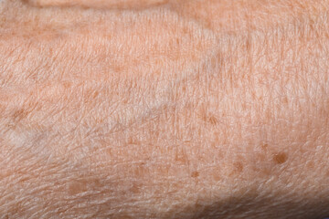 Macro view of skin with birthmarks as background