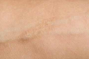 Texture of skin with scar as background, closeup