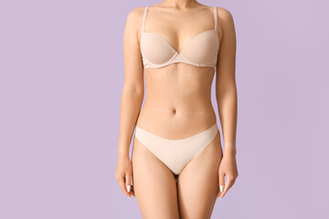 Fototapeta premium Young woman in underwear with marks on her belly against lilac background. Plastic surgery concept