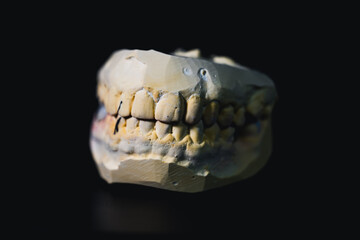 Dental stone model showing the upper and lower jaws clenched, and a metal porcelain denture...