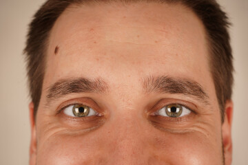 The natural expression highlights the unique details of his skin. A candid portrait focusing on authenticity. A close-up of a man's forehead and eyes, showcasing a visible mole on the side.