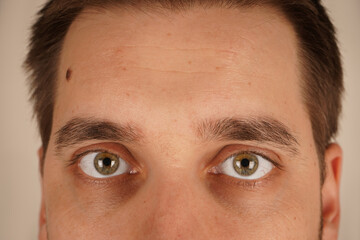 Obraz premium The natural expression highlights the unique details of his skin. A candid portrait focusing on authenticity. A close-up of a man's forehead and eyes, showcasing a visible mole on the side.