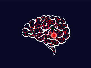 Ischemic stroke. Human brain, red cerebral artery
