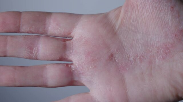 scary hideous looking skin hand affected with skin disease. scabs dry redness flaking inflammation reaction on allergy food intestine problems health concept. 