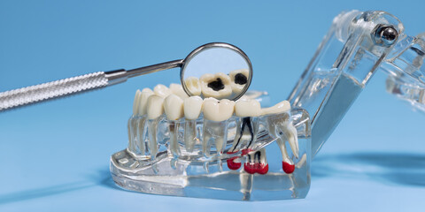 dental model with decayed teeth examined using a dental mirror, illustrating cavities and oral...