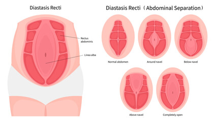 Obraz premium Separation of Abdominal muscle which in medical called Diastasis Recti belly