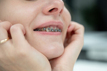 Fototapeta premium Woman smiling with braces on her teeth. 