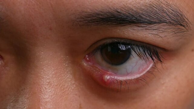 Close Up of Adult Man with one eye infection, Chalazion, Stye (hordeolum) on eyelid.