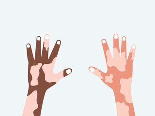 Sowing on the Human Hand Vitiligo world vitiligo day. Skin disease. Self care and self love. Vector illustration