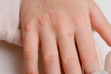 Doctor in medical gloves examines child's hand with viral warts, thinking about method of getting...