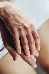 Sick person. Unrecognizable young woman suffering from autoimmune incurable dermatological skin disease called psoriasis. Large red inflamed scaly rash on elbows. joints affected by psoriatic arthriti