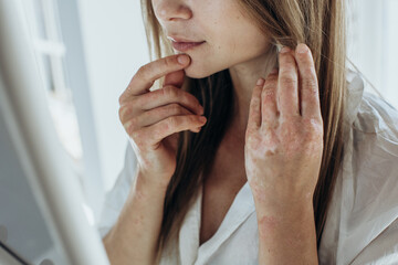 Sick person. Unrecognizable young woman suffering from autoimmune incurable dermatological skin disease called psoriasis. Large red inflamed scaly rash on elbows. joints affected by psoriatic arthriti