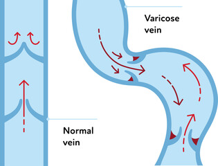 Varicose disease for healthcare infographic. Vector flat chart illustration. Vascular disease diagnostic and treatment. Healthy and changed varicose vein with blood flow. Design for education