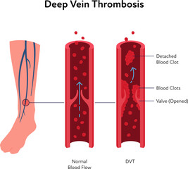 Deep vein thrombosis for healthcare infographic. Vector flat character illustration. Vascular disease diagnostic and treatment. Human veins with DVT and blood clot. Design for health care, education