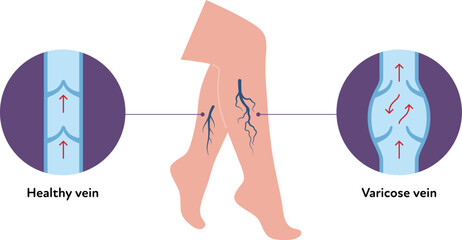 Varicose disease for healthcare infographic collection. Vector flat chart illustration. Vascular disease diagnostic and treatment. Healthy and varicose vein comparison. Design for education