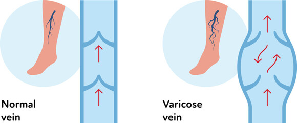 Varicose disease for healthcare infographic collection. Vector flat chart illustration. Vascular disease diagnostic and treatment. Healthy and varicose vein blood flow. Design for education