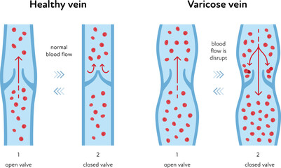 Varicose disease for healthcare infographic. Vector flat chart illustration. Vascular disease diagnostic and treatment. Healthy and varicose vein blood flow. Closed and open valve Design for education