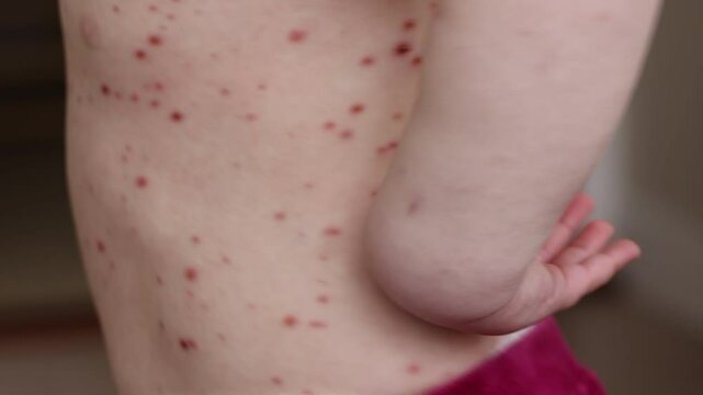 A young child with severe chicken pox illness covered in spots and blisters.