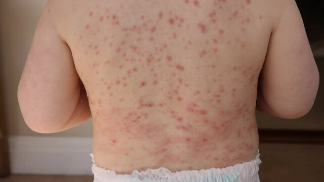 A young child with severe chicken pox illness covered in spots and blisters.