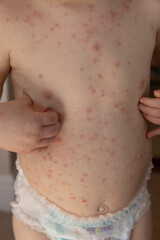Fototapeta premium A young child with severe chicken pox illness covered in spots and blisters