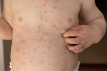 A young child with severe chicken pox illness covered in spots and blisters