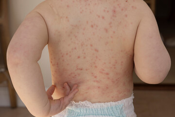 A young child with severe chicken pox illness covered in spots and blisters