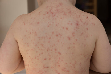 A young child with severe chicken pox illness covered in spots and blisters