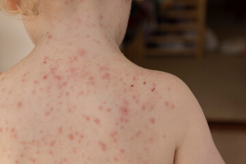 A young child with severe chicken pox illness covered in spots and blisters