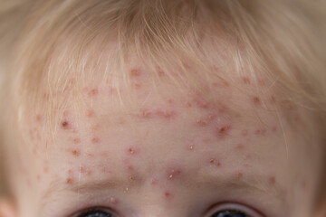 A young child with severe chicken pox illness covered in spots and blisters