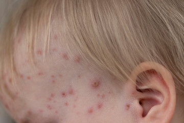 Fototapeta premium A young child with severe chicken pox illness covered in spots and blisters