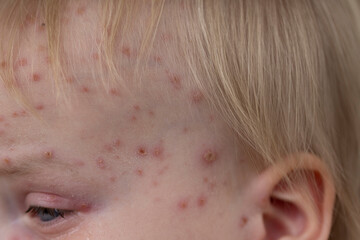 Fototapeta premium A young child with severe chicken pox illness covered in spots and blisters