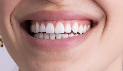 Obraz premium A detailed close-up of a woman’s smile, showcasing white, well-aligned teeth and healthy gums. The natural lighting highlights the smooth skin texture and subtle lip color
