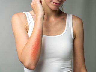 Arm Rash Woman Red Skin Irritation - Dermatitis Symptom