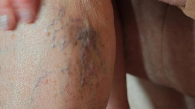 Woman applies cream to her sore leg with varicose veins