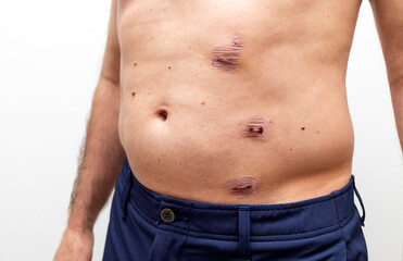 Naklejka premium Closeup Scars On Abdomen After Removal Of Appendicitis And Abdominal Surgery. Inflammation Of Appendix, Appendectomy Surgical Procedure. Horizontal.