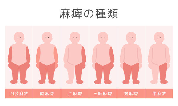 麻痺の種類　イラスト
