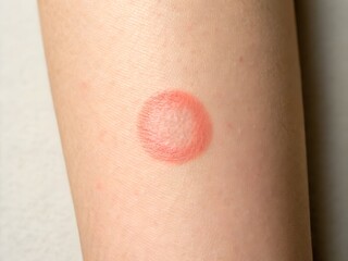 Fototapeta premium Close-Up of a Skin Rash or Irritation on a Person's Arm