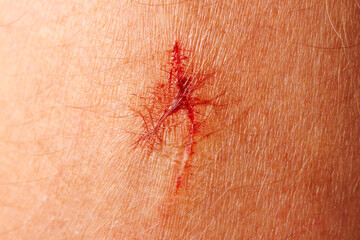 A small red mark on a person's arm