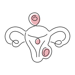 Uterine Fibroids medical illustration