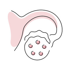 PCOS, Polycystic Ovary Syndrome medical illustration