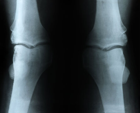 X-ray image of knee joint on white background