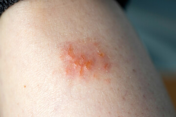Fototapeta premium Close up on atopic dermatitis, eczema on leg.